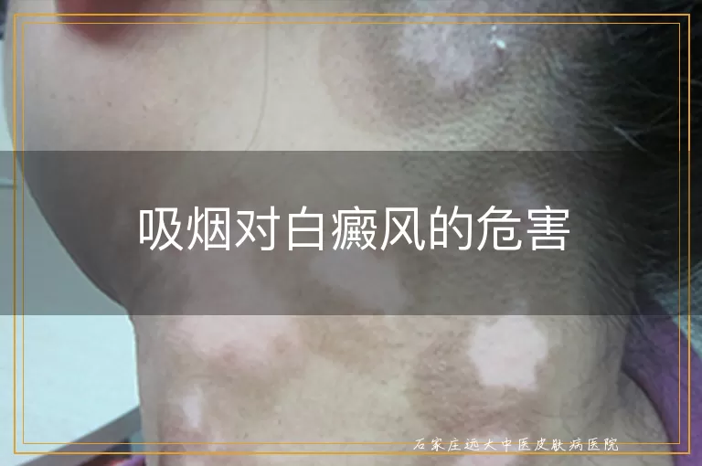 吸烟对白癜风的危害