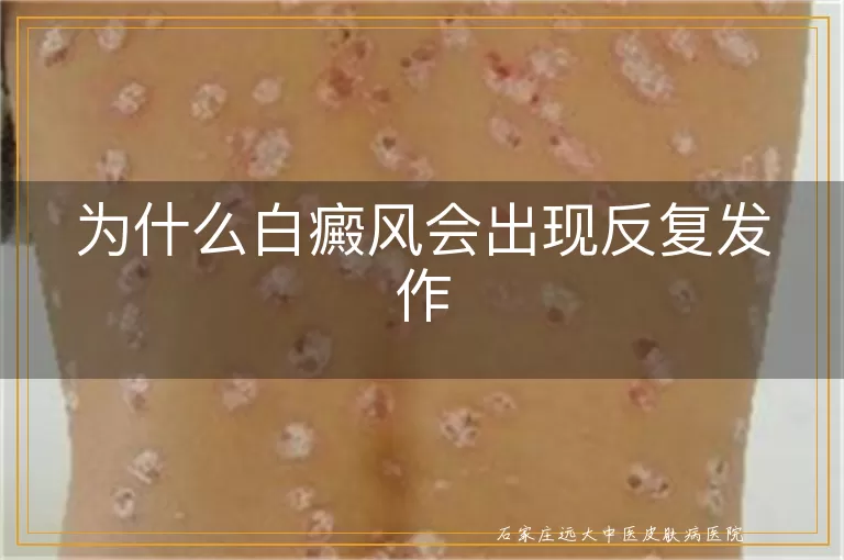 为什么白癜风会出现反复发作