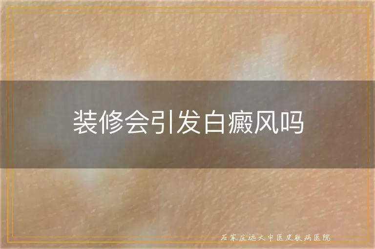 装修会引发白癜风吗