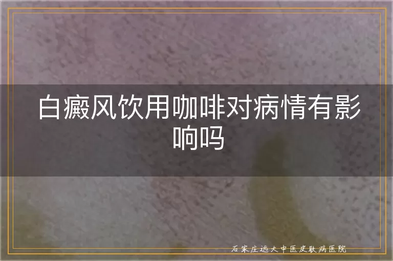 白癜风饮用咖啡对病情有影响吗