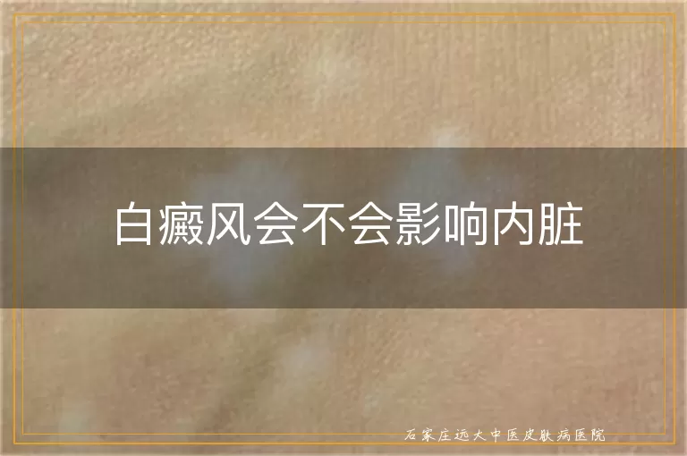 白癜风会不会影响内脏