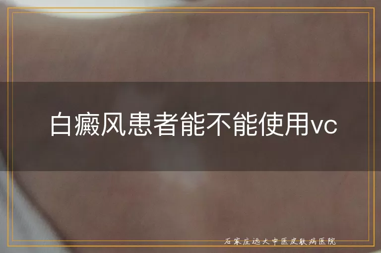 白癜风患者能不能使用vc