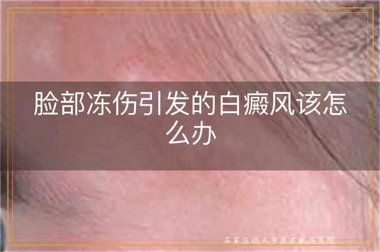 脸部冻伤引发的白癜风该怎么办