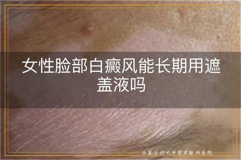女性脸部白癜风能长期用遮盖液吗