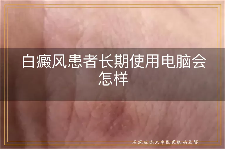 白癜风患者长期使用电脑会怎样