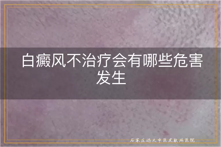 白癜风不治疗会有哪些危害发生