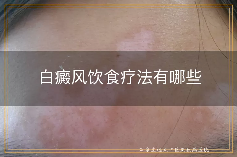 白癜风饮食疗法有哪些