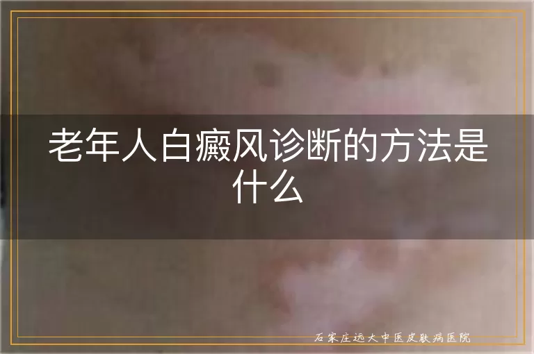 老年人白癜风诊断的方法是什么