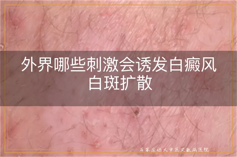 外界哪些刺激会诱发白癜风白斑扩散