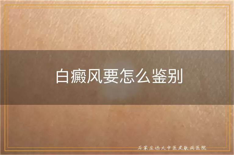 白癜风要怎么鉴别