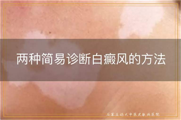两种简易诊断白癜风的方法