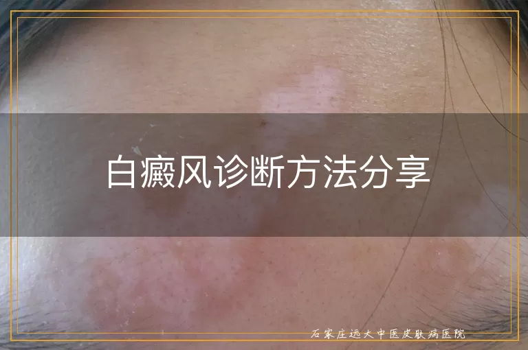 白癜风诊断方法分享