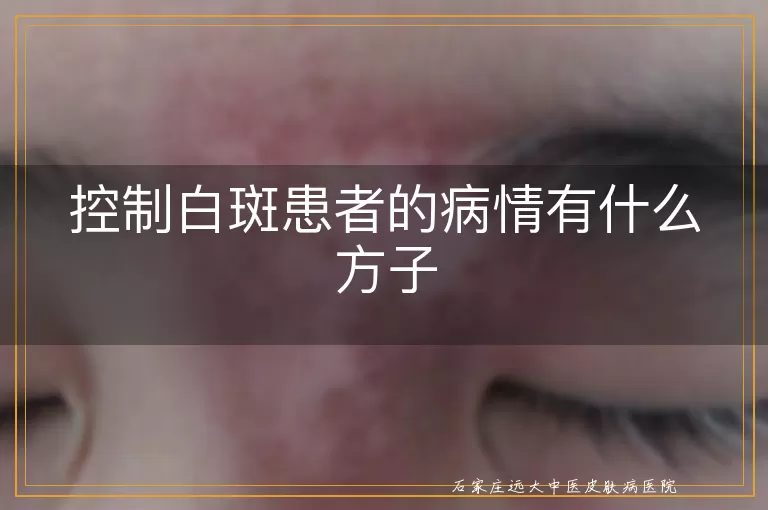 控制白斑患者的病情有什么方子
