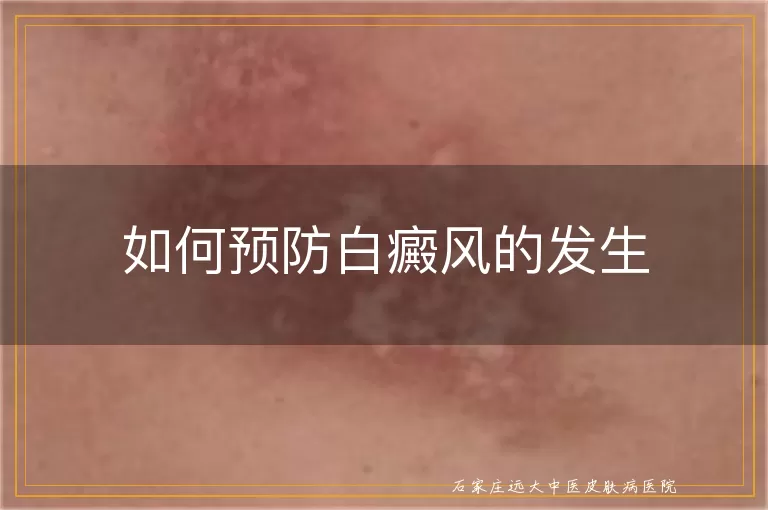 如何预防白癜风的发生