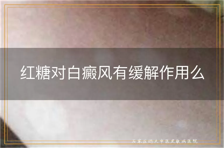 红糖对白癜风有缓解作用么