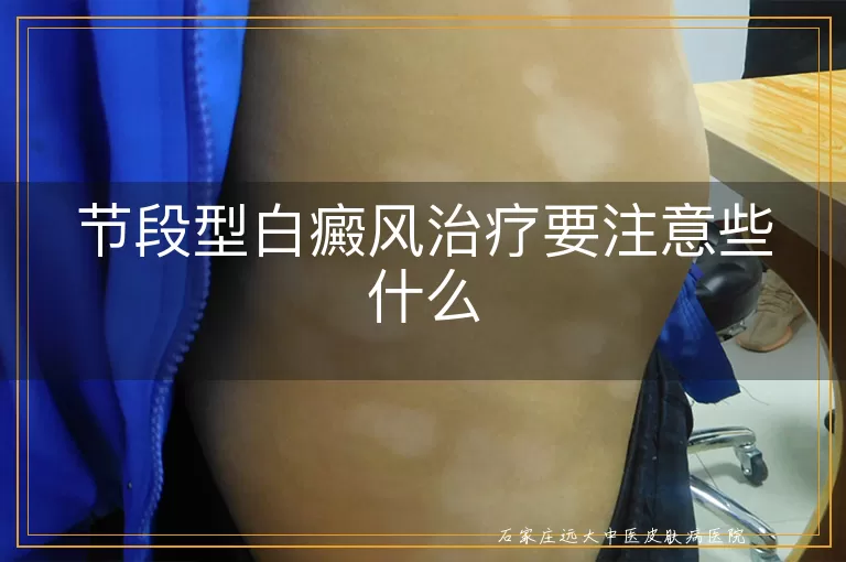 节段型白癜风治疗要注意些什么