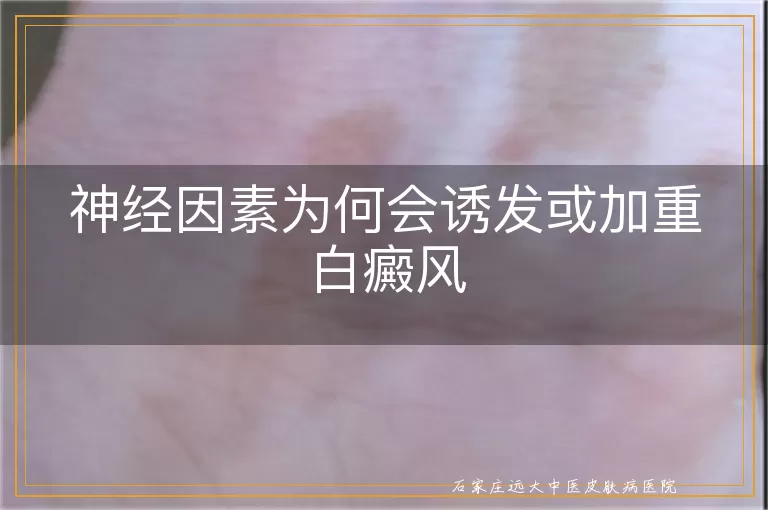 神经因素为何会诱发或加重白癜风