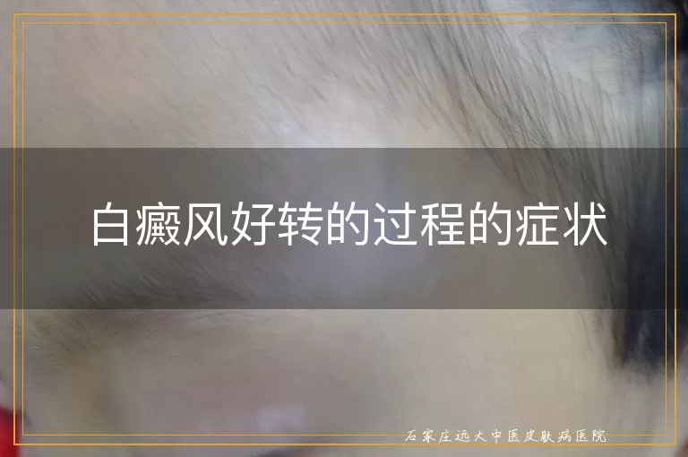 白癜风好转的过程的症状