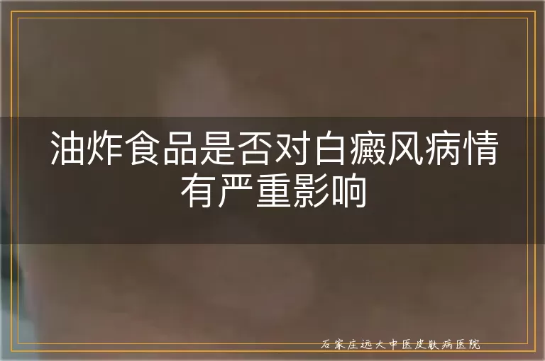 油炸食品是否对白癜风病情有严重影响