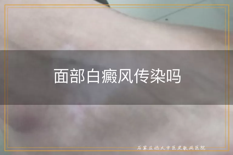 面部白癜风传染吗