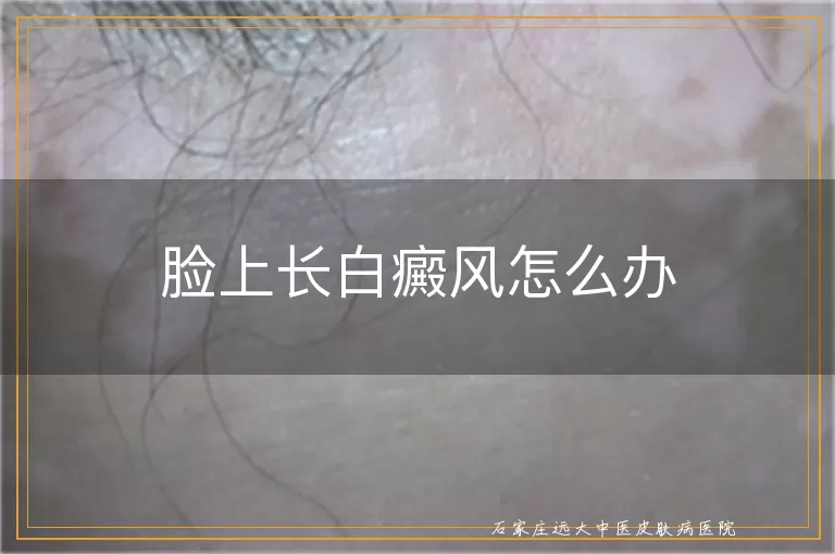 脸上长白癜风怎么办
