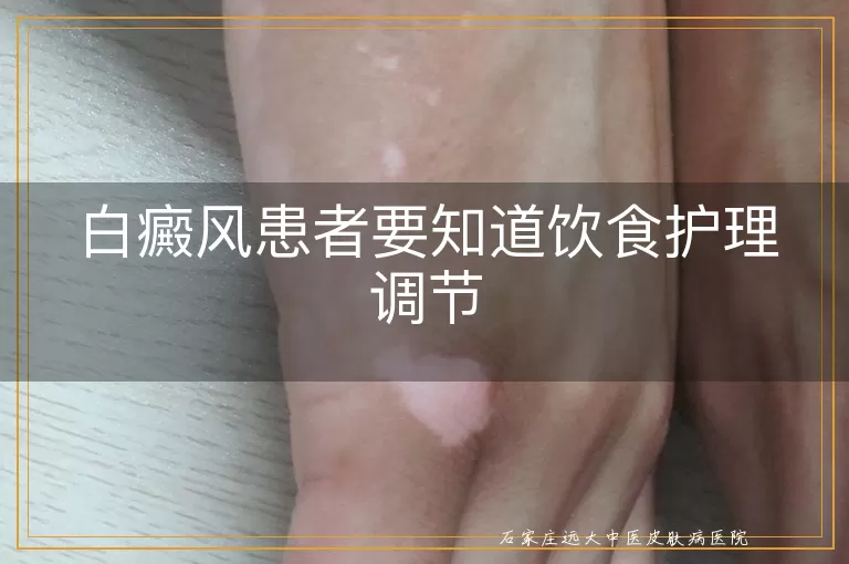白癜风患者要知道饮食护理调节