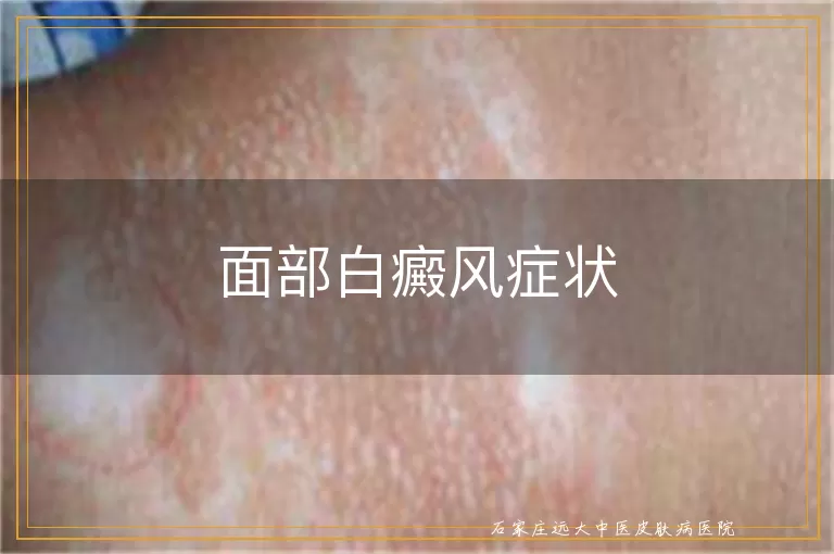 面部白癜风症状