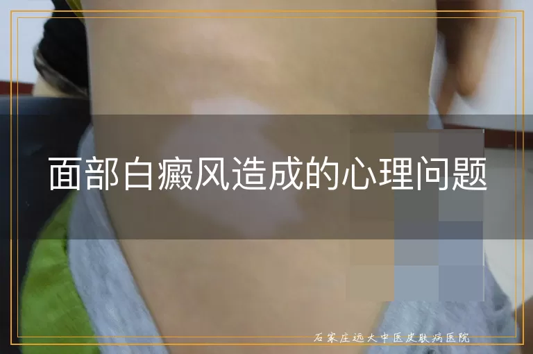 面部白癜风造成的心理问题