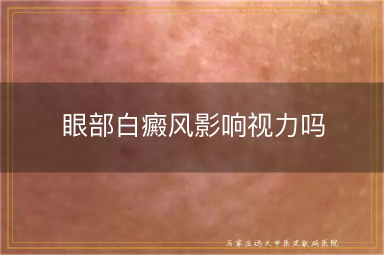 眼部白癜风影响视力吗