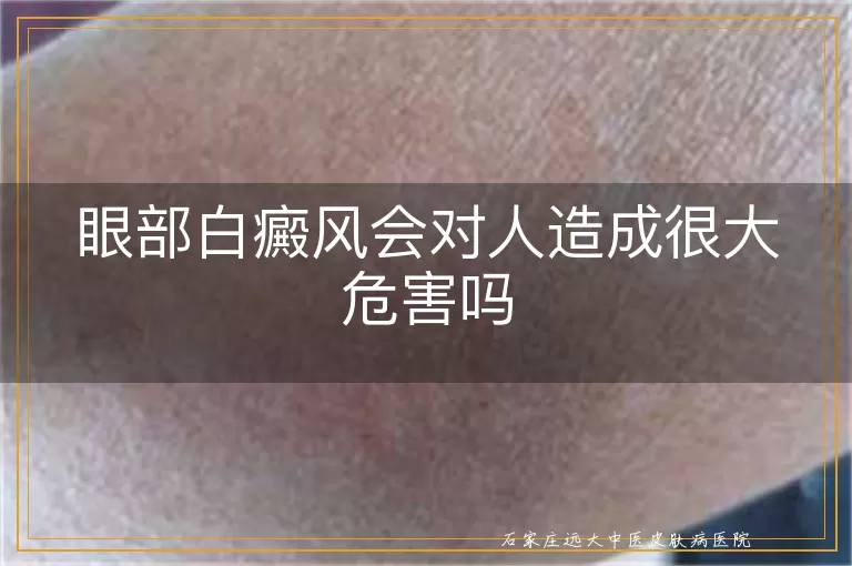 眼部白癜风会对人造成很大危害吗