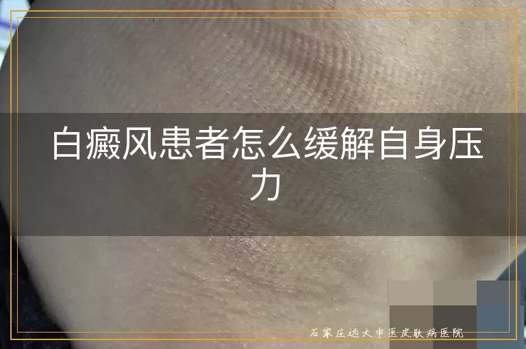 白癜风患者怎么缓解自身压力