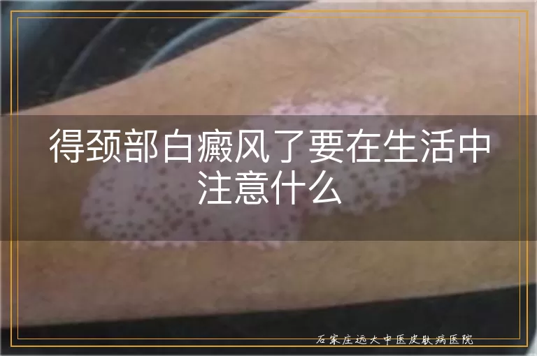 得颈部白癜风了要在生活中注意什么