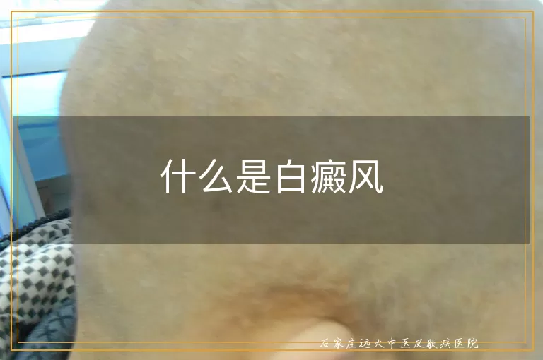 什么是白癜风