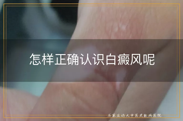 怎样正确认识白癜风呢