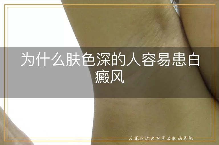 为什么肤色深的人容易患白癜风