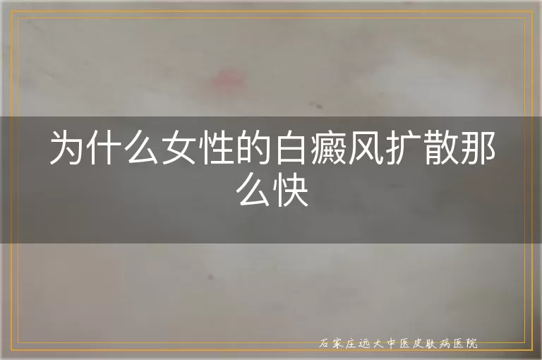 为什么女性的白癜风扩散那么快