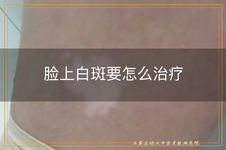 脸上白斑要怎么治疗