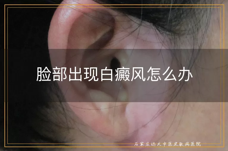脸部出现白癜风怎么办