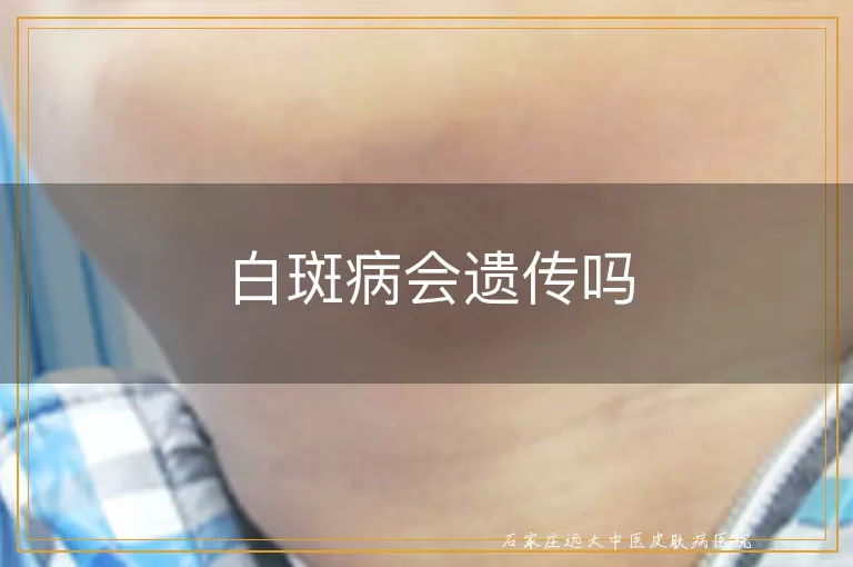 白斑病会遗传吗