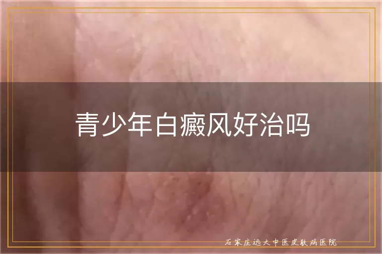 青少年白癜风好治吗