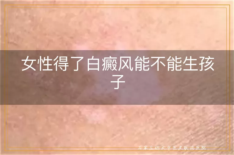 女性得了白癜风能不能生孩子