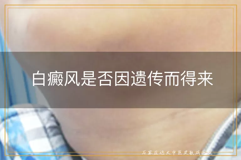 白癜风是否因遗传而得来