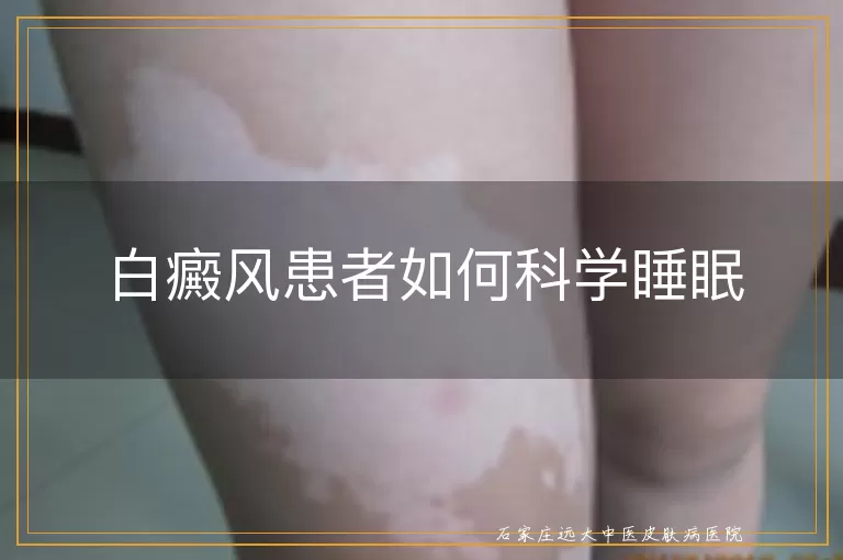白癜风患者如何科学睡眠