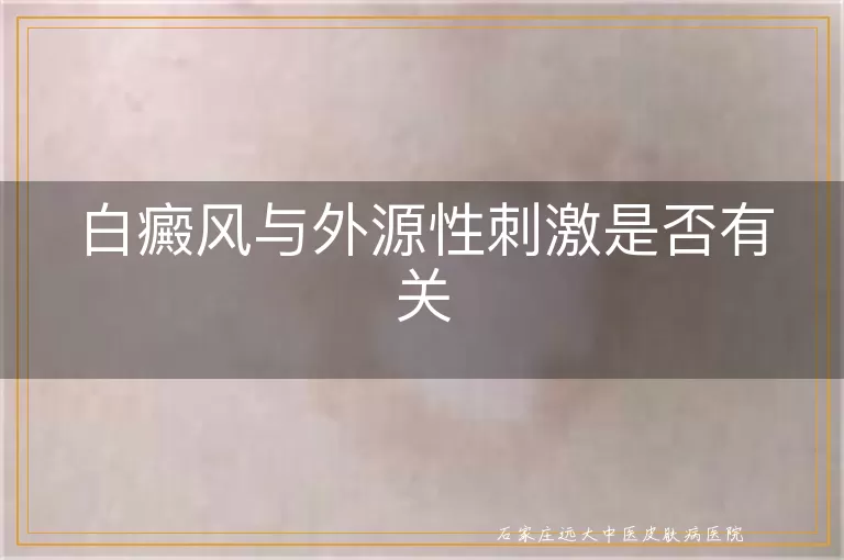 白癜风与外源性刺激是否有关