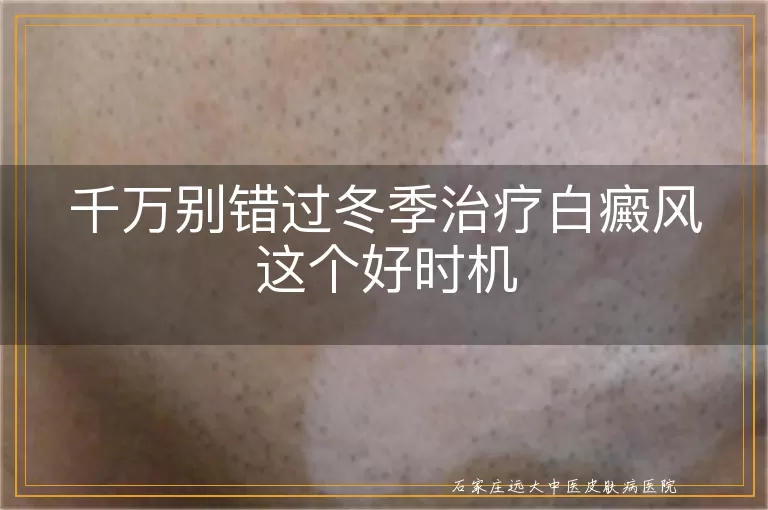 千万别错过冬季治疗白癜风这个好时机