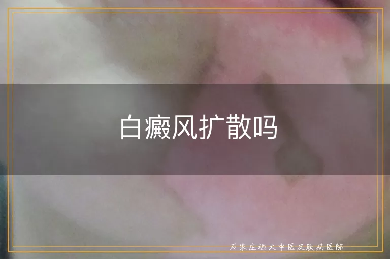 白癜风扩散吗