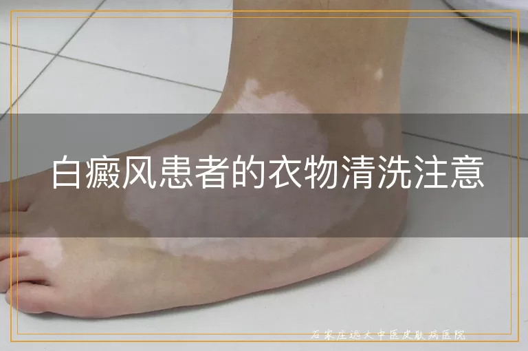 白癜风患者的衣物清洗注意