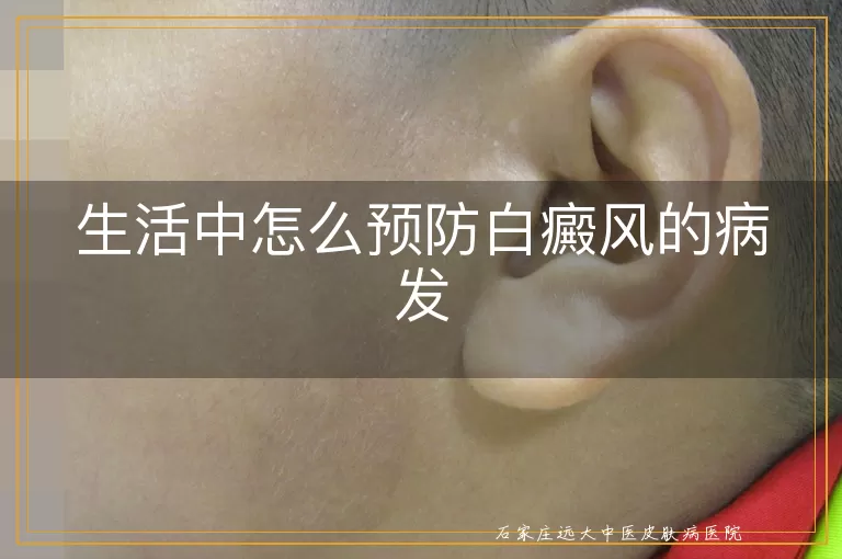 生活中怎么预防白癜风的病发