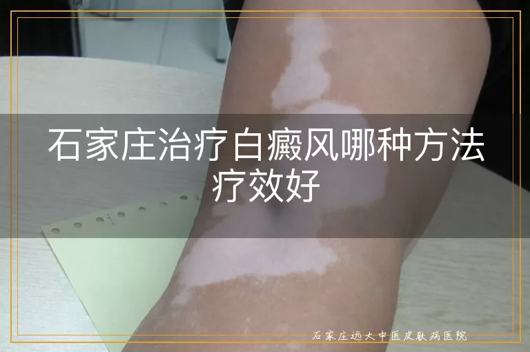 石家庄治疗白癜风哪种方法疗效好