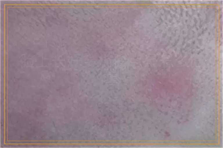 脸上长好多小白点是怎么回事